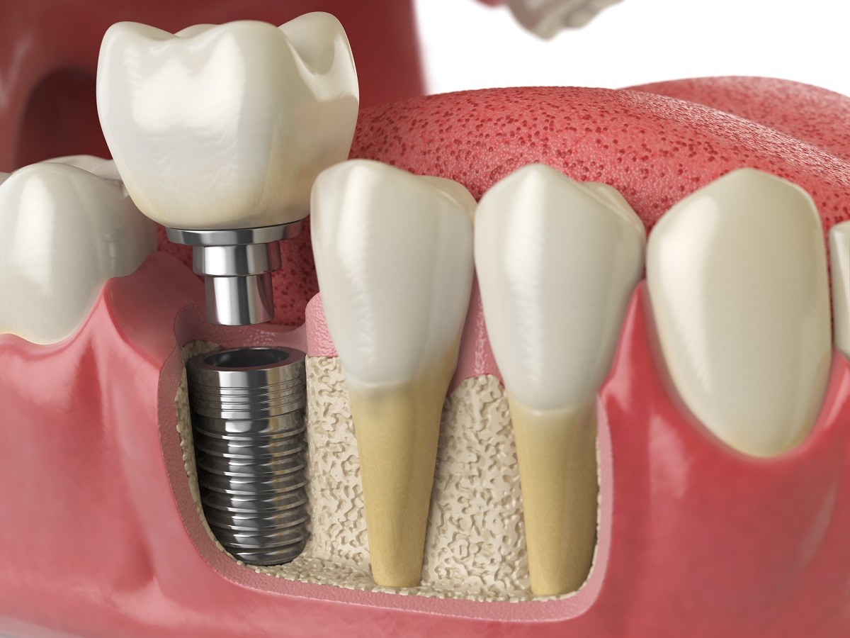 implante dental quanto custa