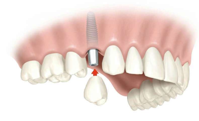 Implante dentário carga imediata