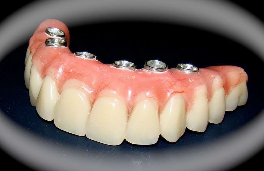 implante dentário carga imediata