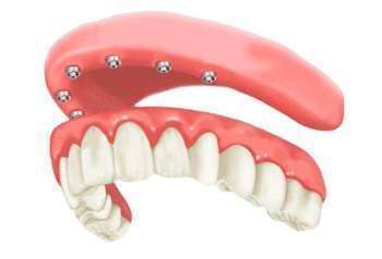 implante dentário carga imediata