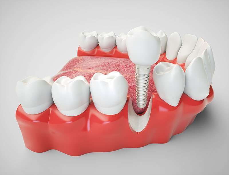 implante dentário dente da frente