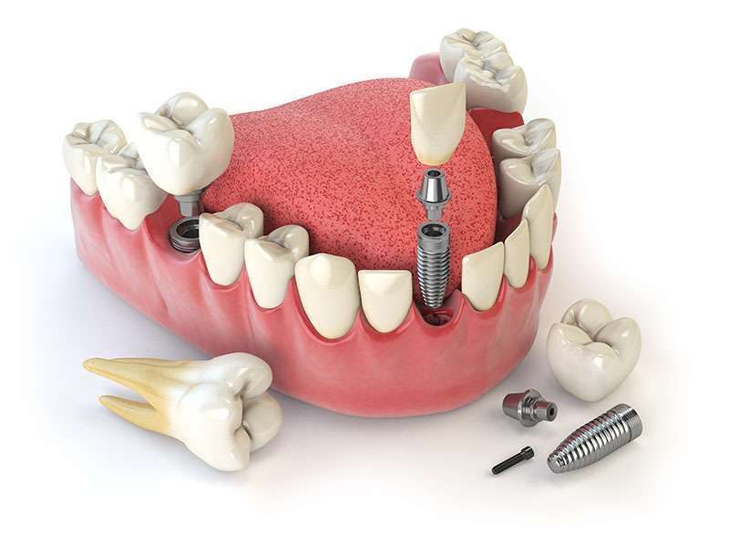 Implante dentário quanto custa