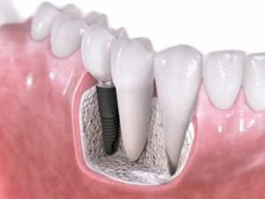 implante dentário quanto custa em média