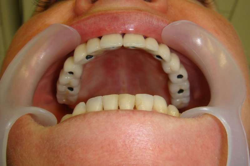 implante dentário superior