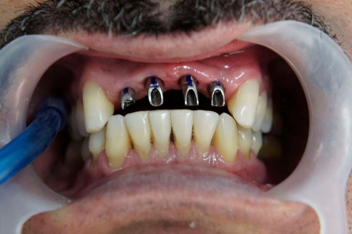 implante dente da frente