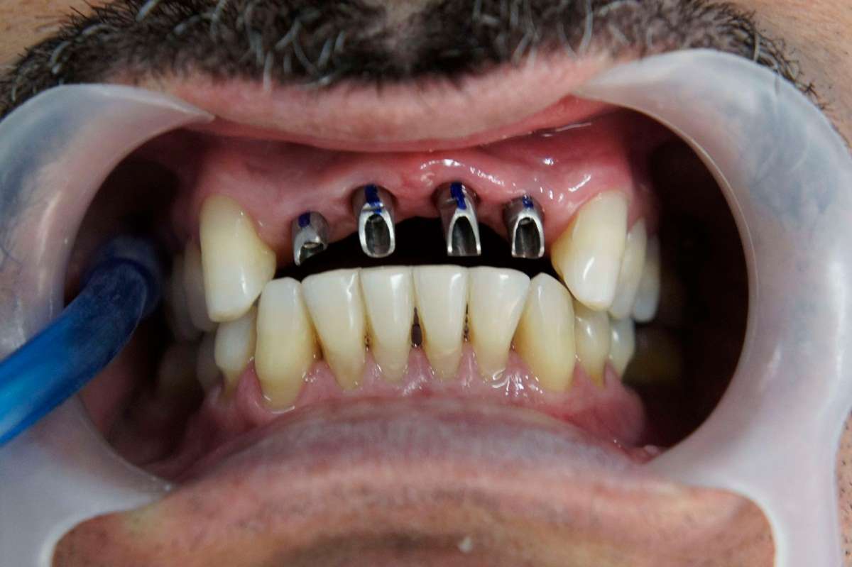 Implante dente da frente - Consulta Ideal