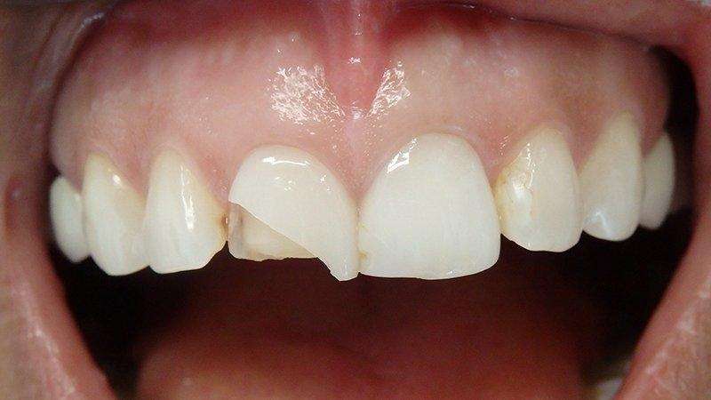 Lente de contato dental quanto custa