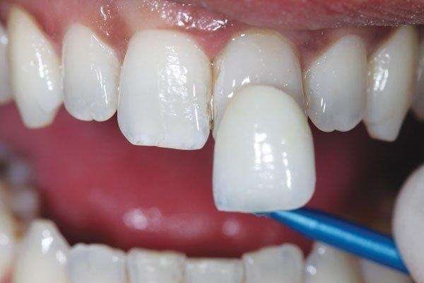 Lente de contato para dentes