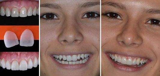 Lente de contato pros dentes