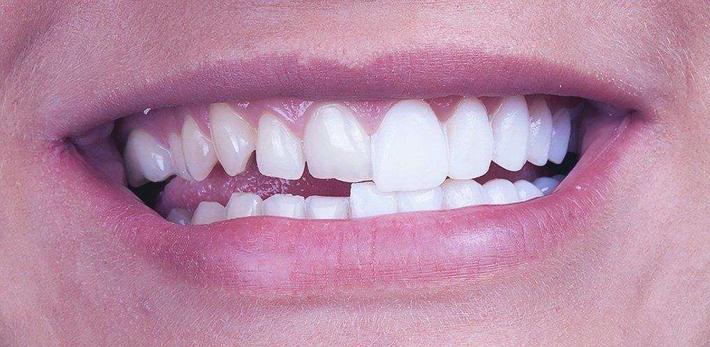 Lente dental