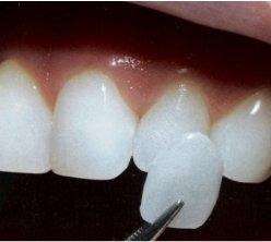 Lente para dentes