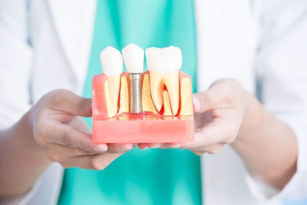 onde fazer implante dentário