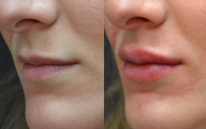 preenchimento labial com gordura