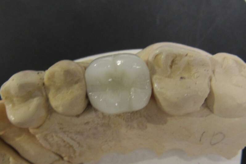 prótese dentaria de porcelana