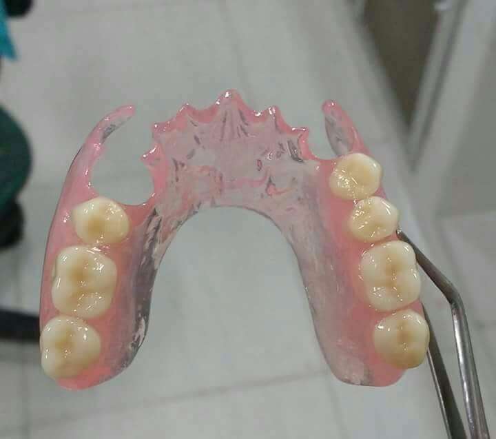 prótese dentária de silicone