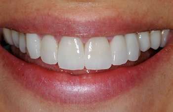 Prótese dentes da frente