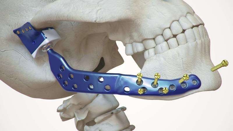 prótese mandibular
