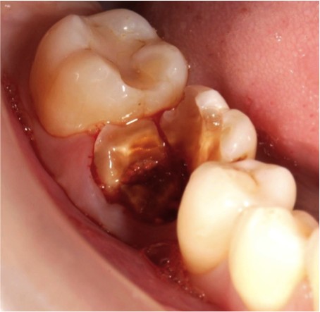 Tratamento da carie dentaria