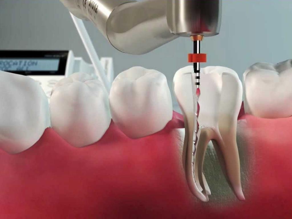 Tratamento de canal dentário