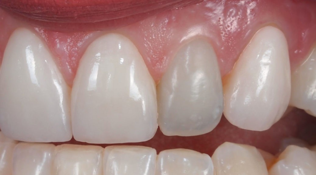 tratamento de canal dente da frente