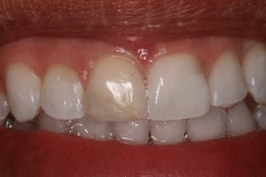 tratamento de canal dente da frente