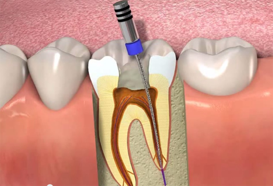 tratamento de canal endodontia