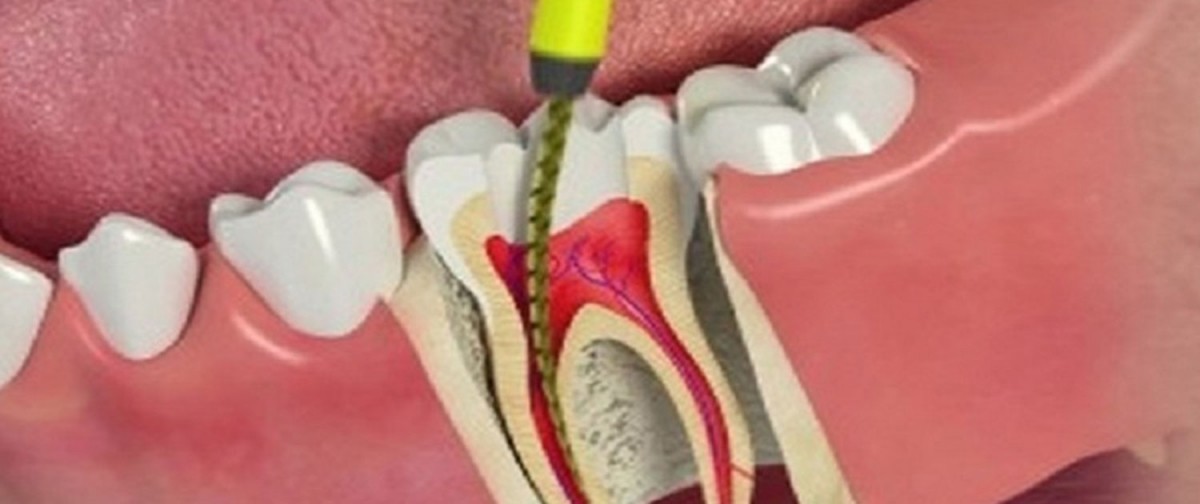 tratamento de canal no dente