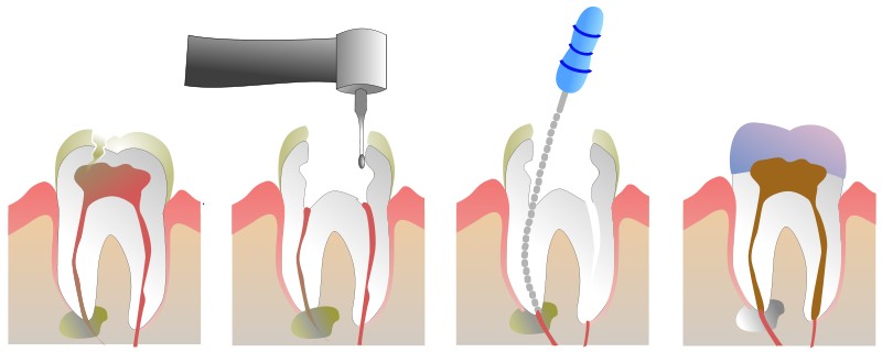 tratamento dentário canal