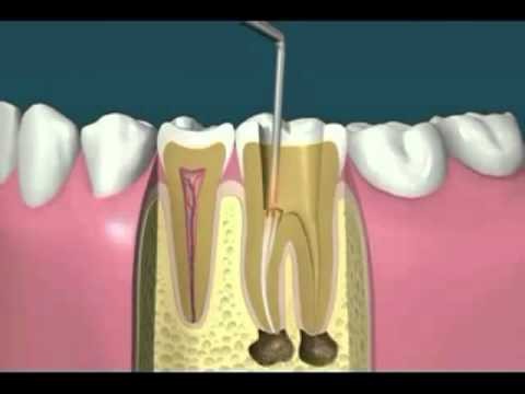 tratamento dentário canal