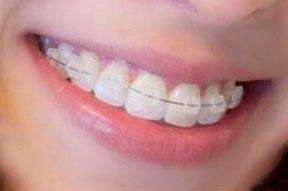 Aparelho Dentário De Porcelana