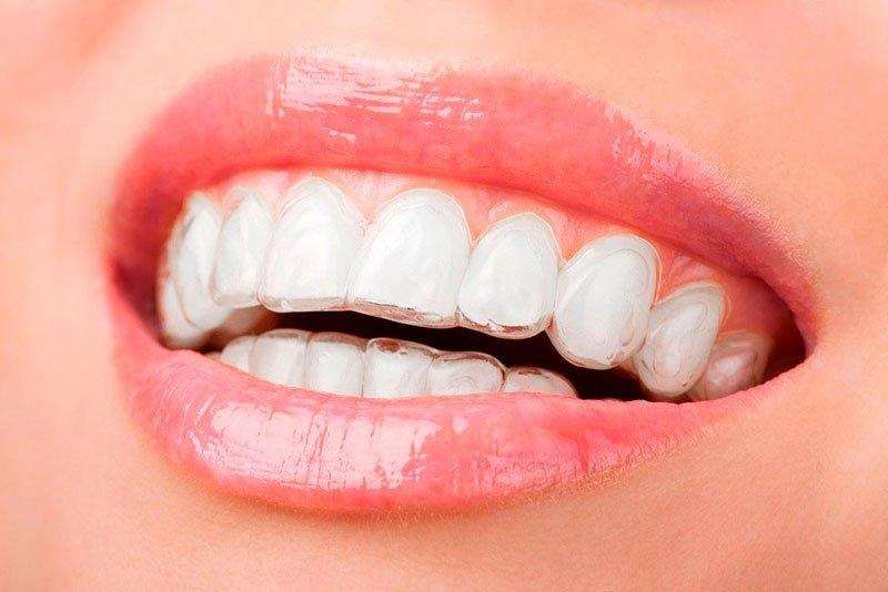 Aparelho Dentário Móvel