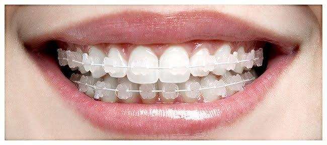 Aparelho Odontológico Estético