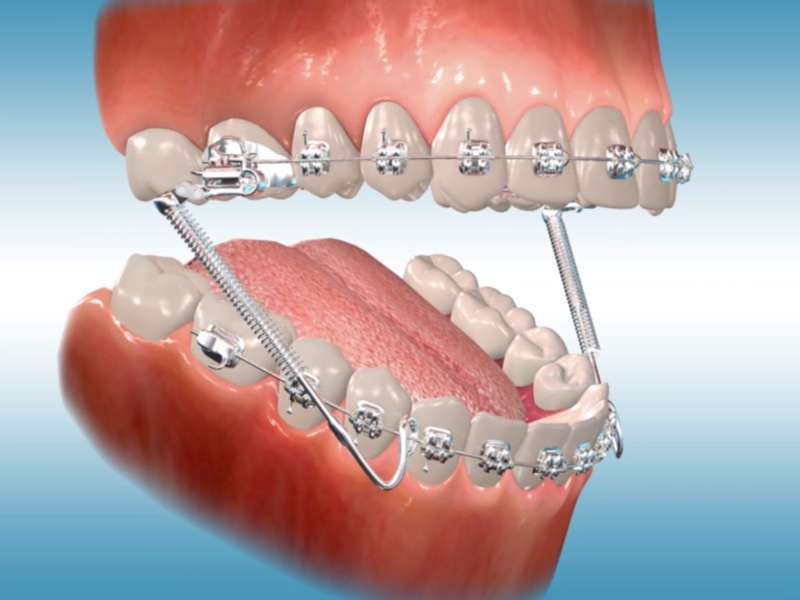 Aparelho ortodôntico invisível: corrigir os dentes sem aparelho fixo é  possível - Ortodontia Curitiba