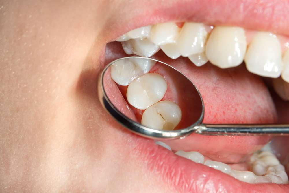 Carie Dentaria Tratamento