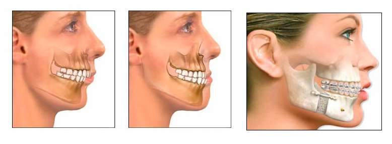 Cirurgia Buco Maxilo Facial