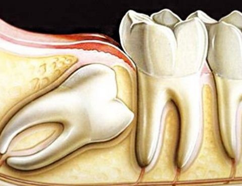 Cirurgia De Dente Incluso