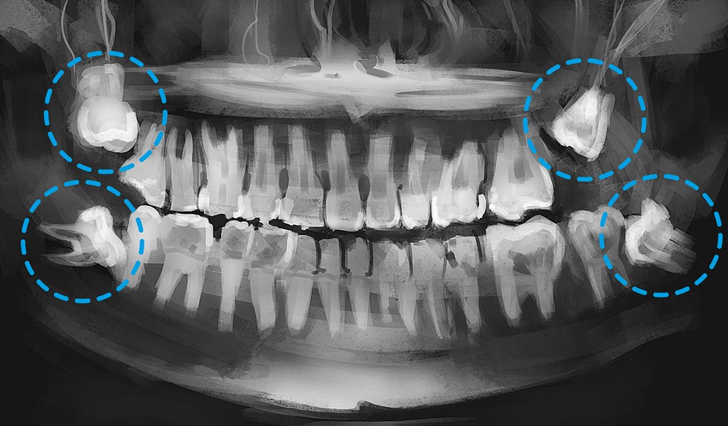 Cirurgia De Extração De Dente