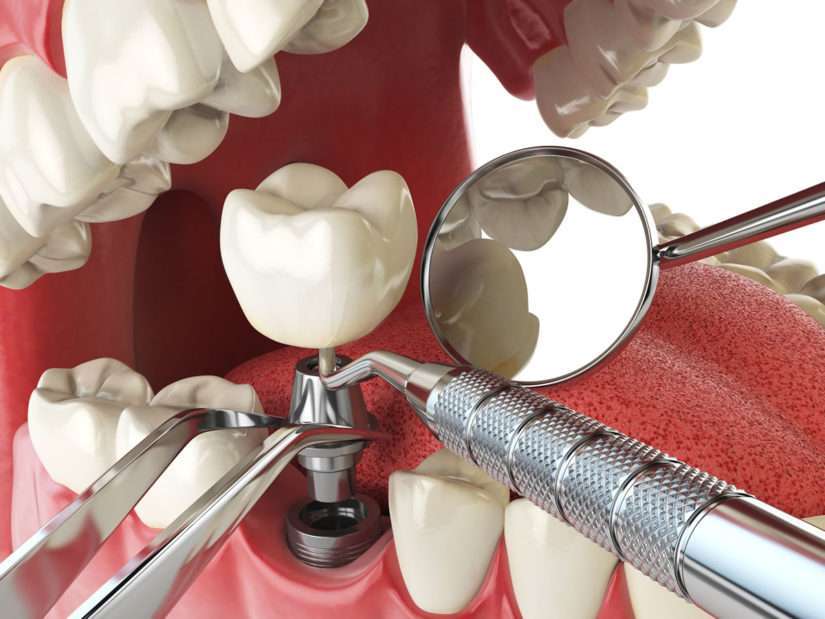Cirurgia De Implante Dentário