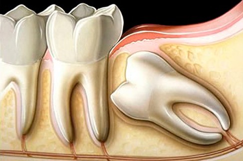Cirurgia Dente Siso