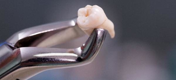 Cirurgia Para Arrancar Dente Siso