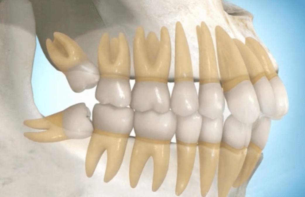 Cirurgia Para Tirar Dente Do Siso