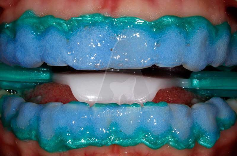 Clareamento Dental No Dentista