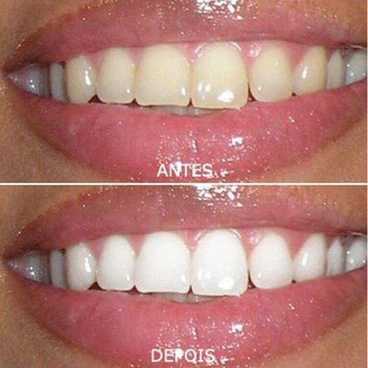 Clareamento Dos Dentes