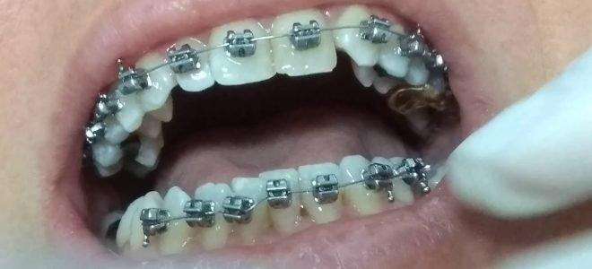 Colocação De Aparelho Dentário