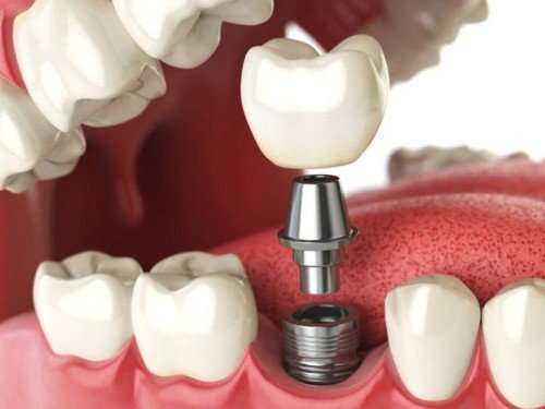 Implante De Dente
