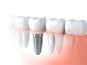 Implante De Dente