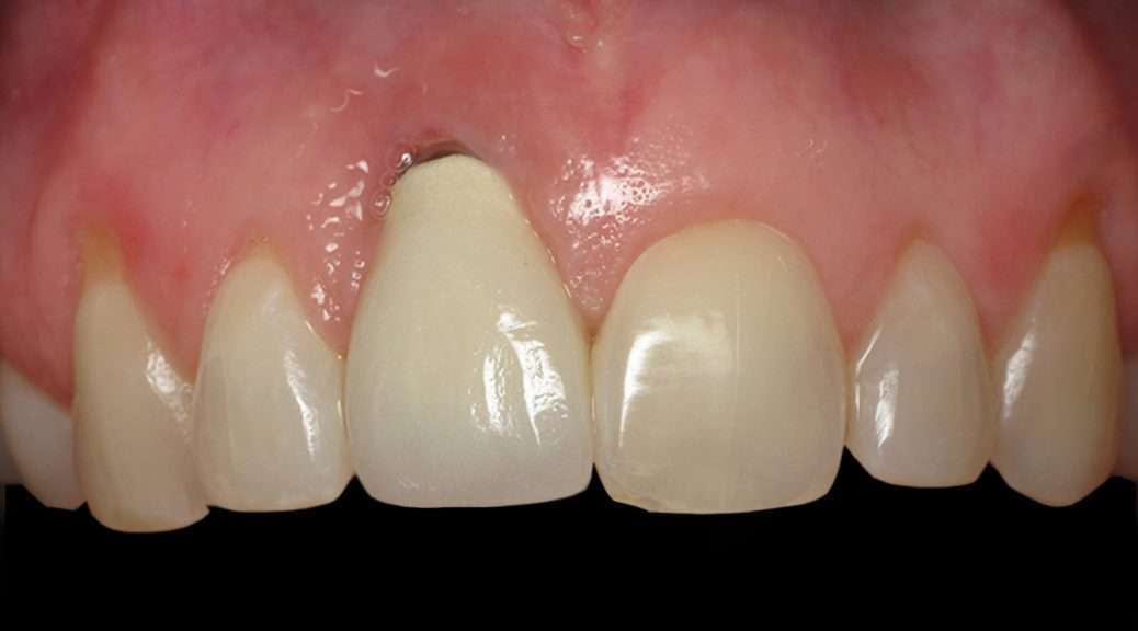 Implante Dentário Dente Da Frente