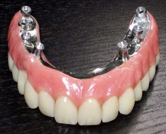 Implante Dentário Superior