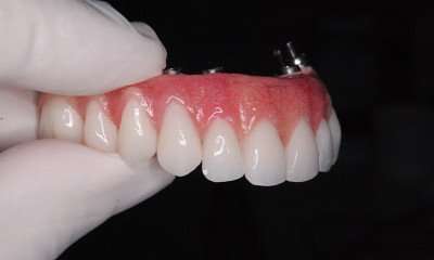 implante total dos dentes
