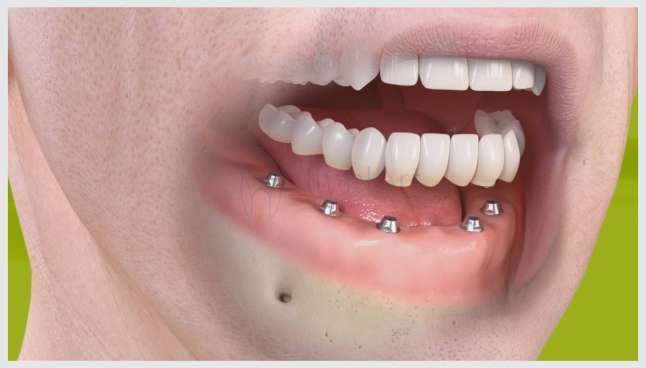 implante total dos dentes